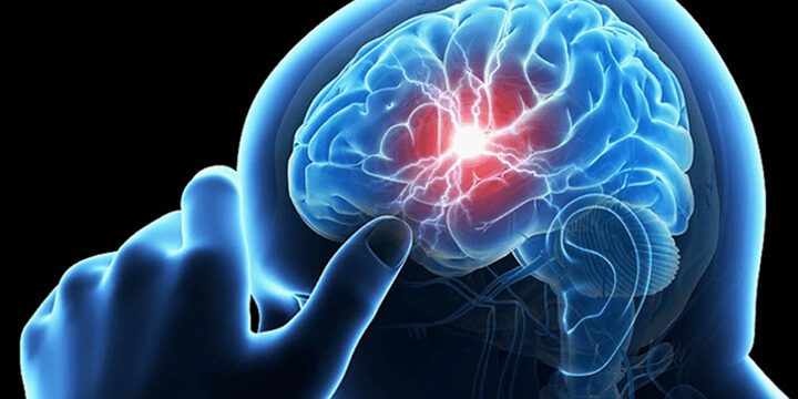 Яка медична допомога гарантована внутрішньо переміщеним особам при інсульті 